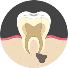 치아 끝 염증 발생